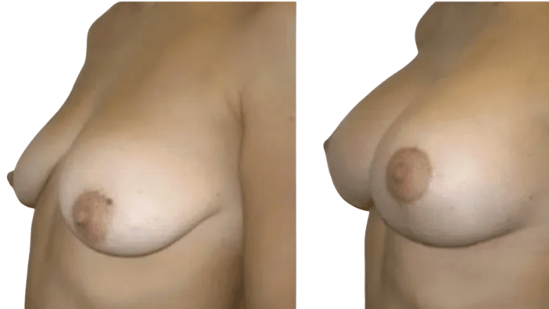 breast lift before and after case 5