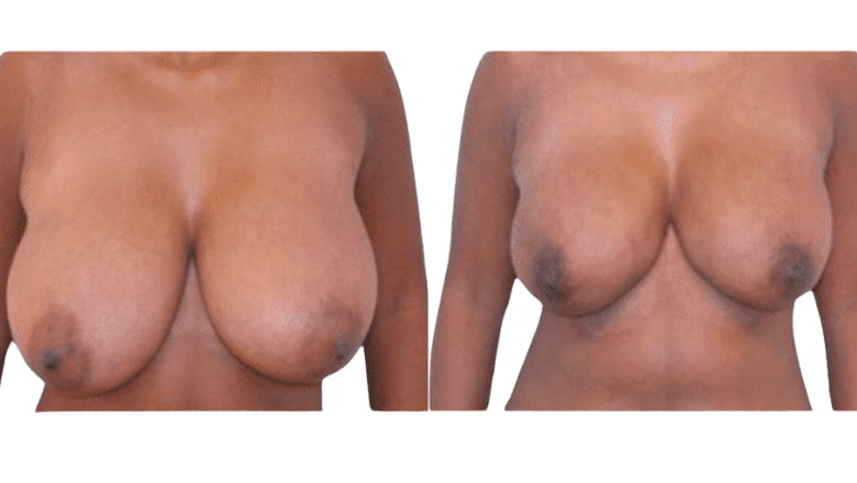 breast liposuction before and after case 1 view 2