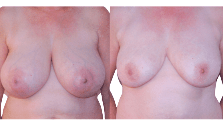 breast liposuction before and after case 1