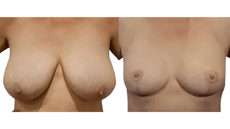 breast reduction before and after case 14