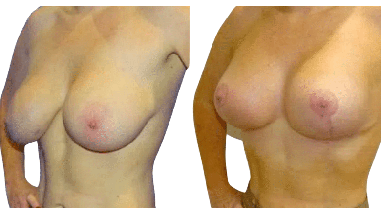 breast reduction before and after case 20