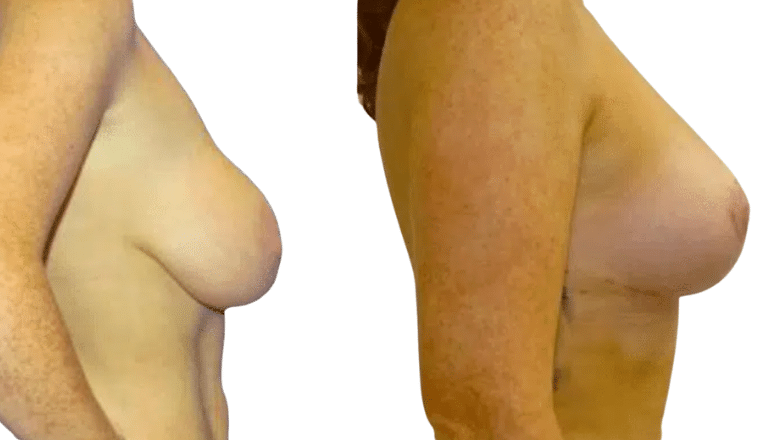 breast reduction before and after case 17