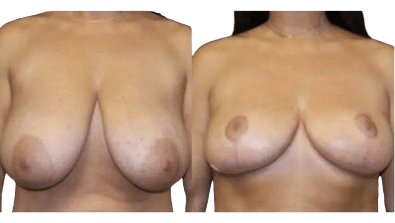 breast reduction before and after case 18