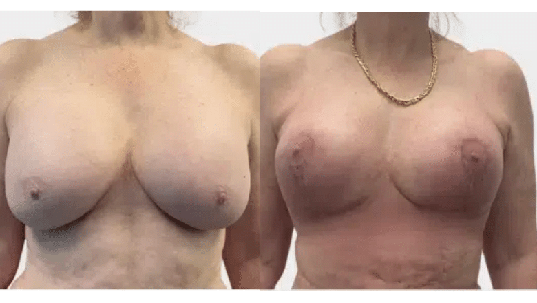 breast reduction before and after case 19