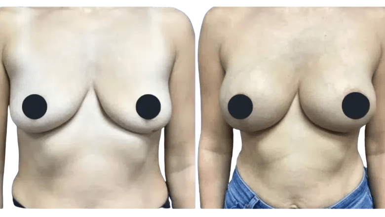 breast uplift front view before and after case 8