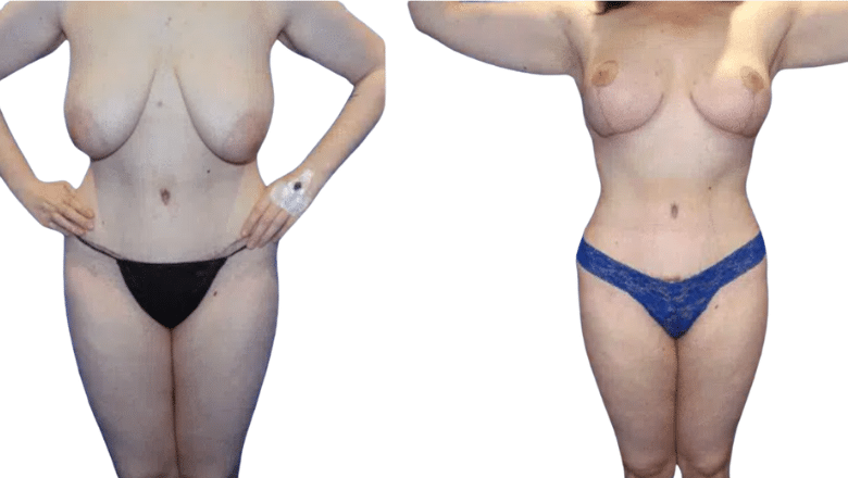breast lift specialist London before and after case 9
