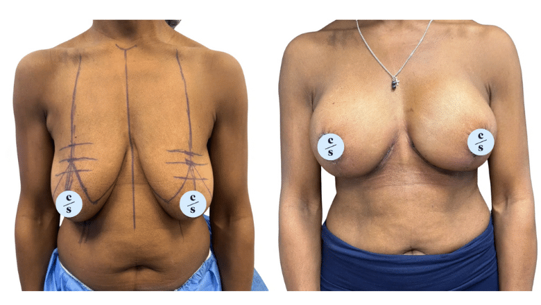 breast uplift before and after case 2