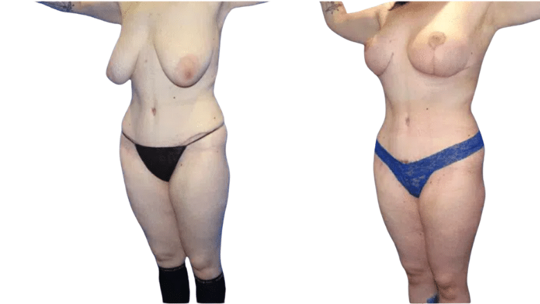 mastopexy before and after case 3