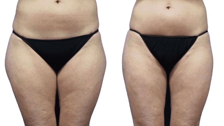cosmetic liposuction before and after London