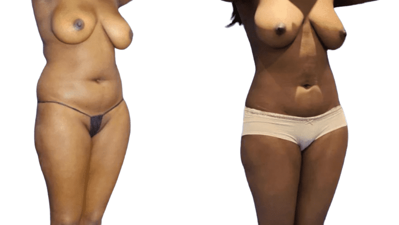 fat removal surgery before and after London