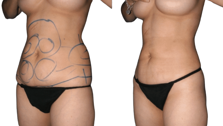 liposuction before and after Greater London