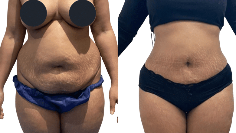 Liposuction UK