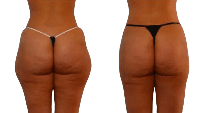 liposuction results before and after London