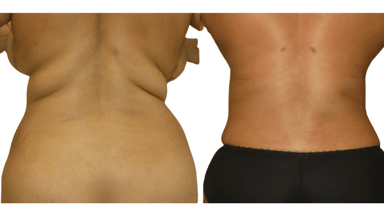 liposuction before and after case 13