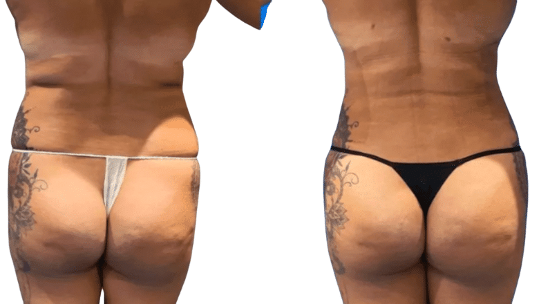 liposuction before and after case 14