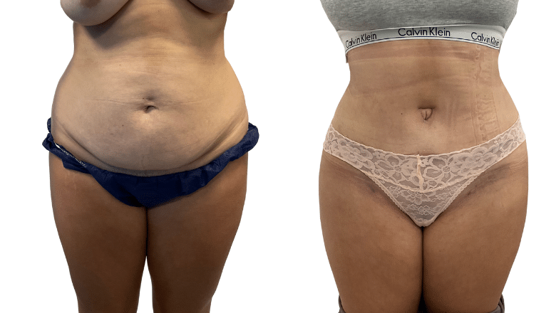 tummy tuck with liposuction before and after
