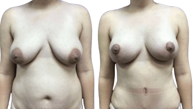 tummy tuck London UK before and after