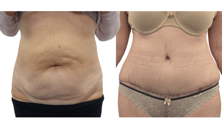 tummy tuck result before and after