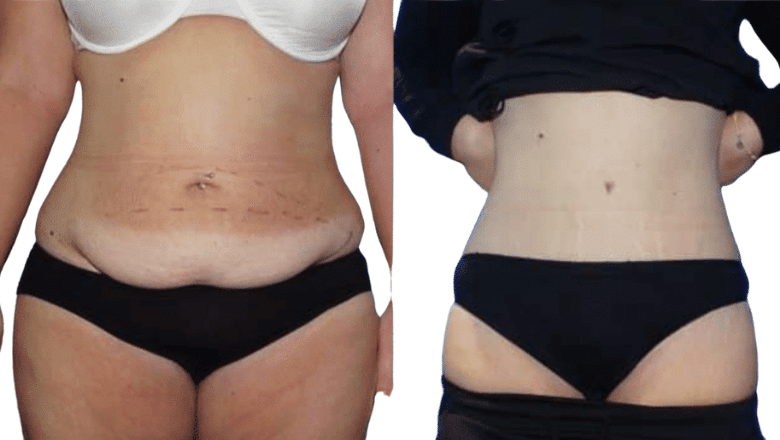 Tummy-Tuck-Surgery-UK
