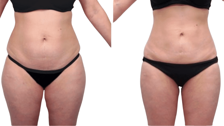 Vaser liposuction before and after London