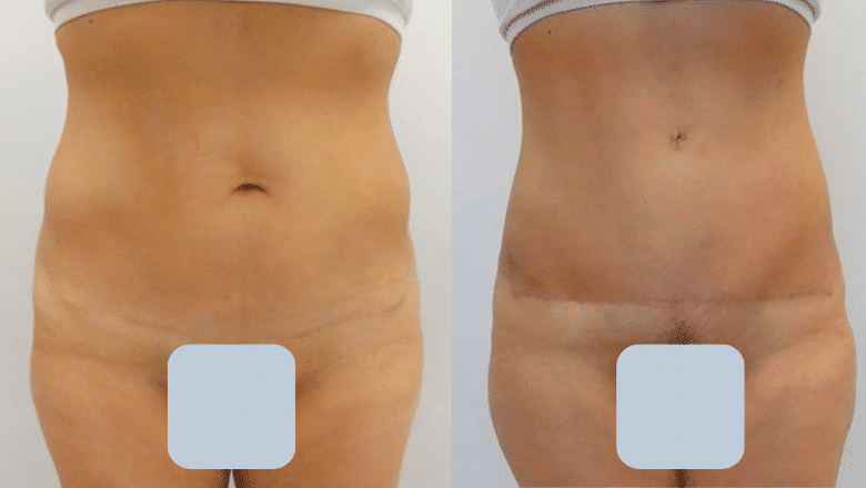 abdominoplasty before and after case 13
