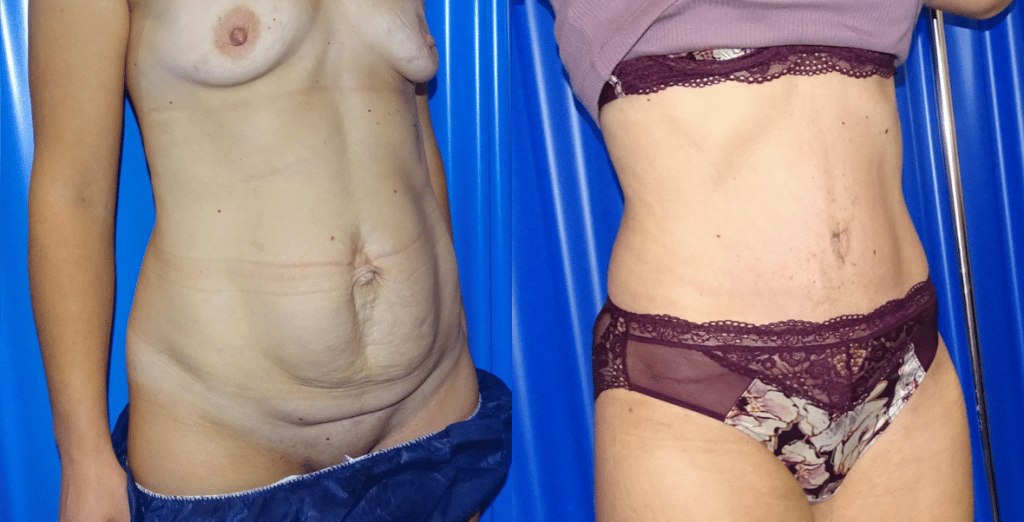 abdominoplasty London before and after case 16 view 2