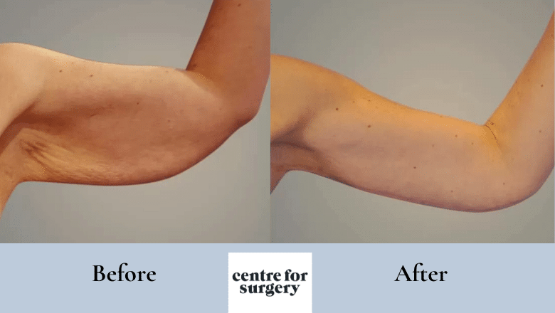 brachioplasty before and after case 1