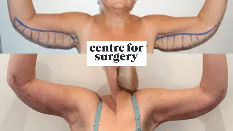 brachioplasty before and after results case 5