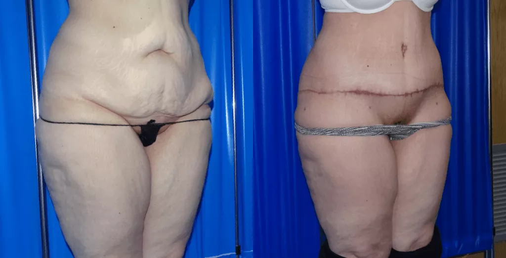Brazilian tummy tuck before and after case 9