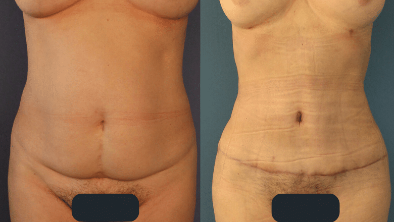 Brazilian tummy tuck before and after case 9 view 2