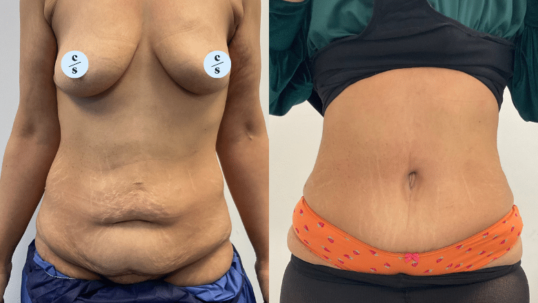 full tummy tuck before after