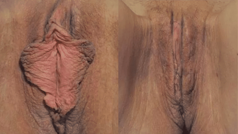 labiaplasty-surgery-before-after-17