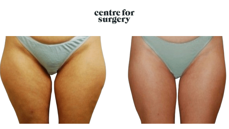 liposuction before and after photos London