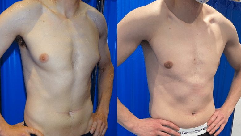 male breast reduction before and after case 7 view 2