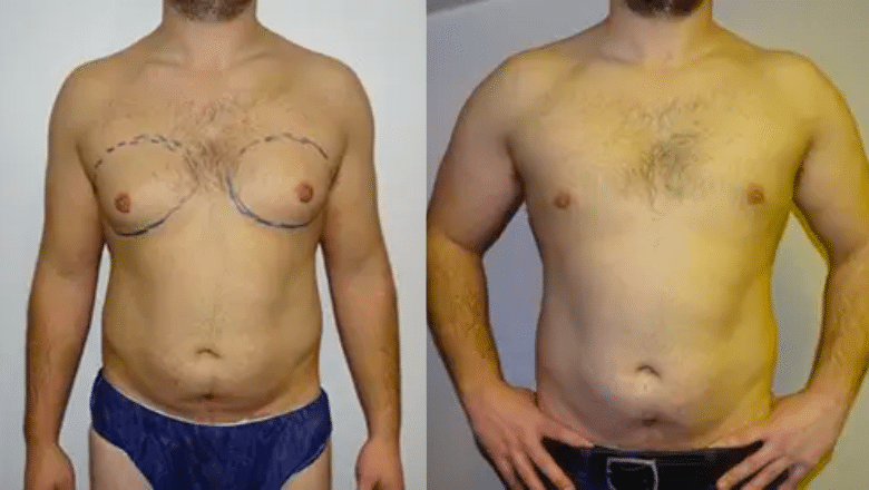 male breast reduction before and after case 4