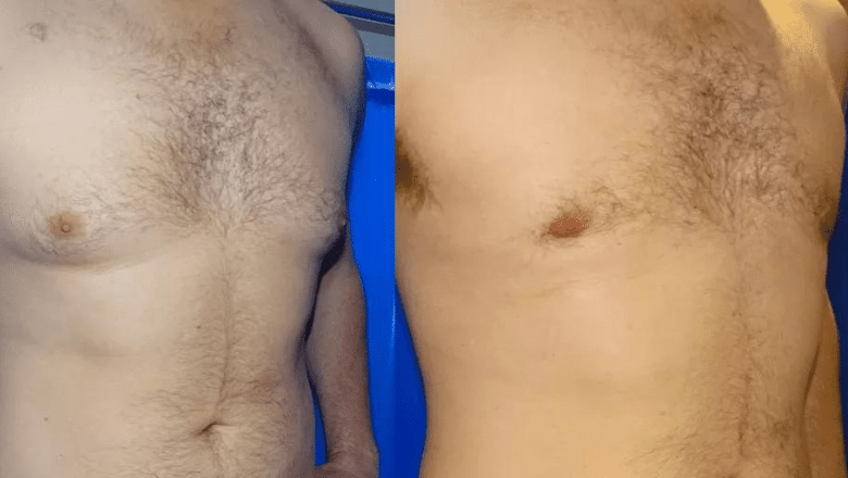 male breast reduction surgery before and after case 9