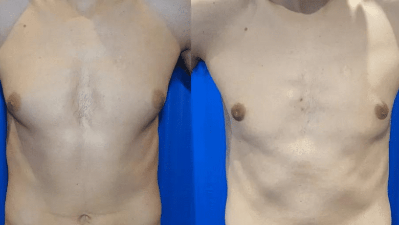 male breast reduction before and after case 7