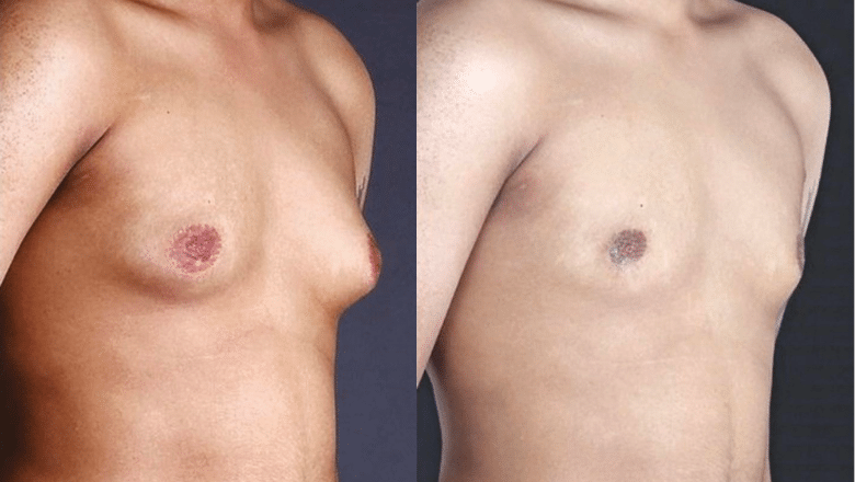 BodyTite gynecomastia before and after case 8