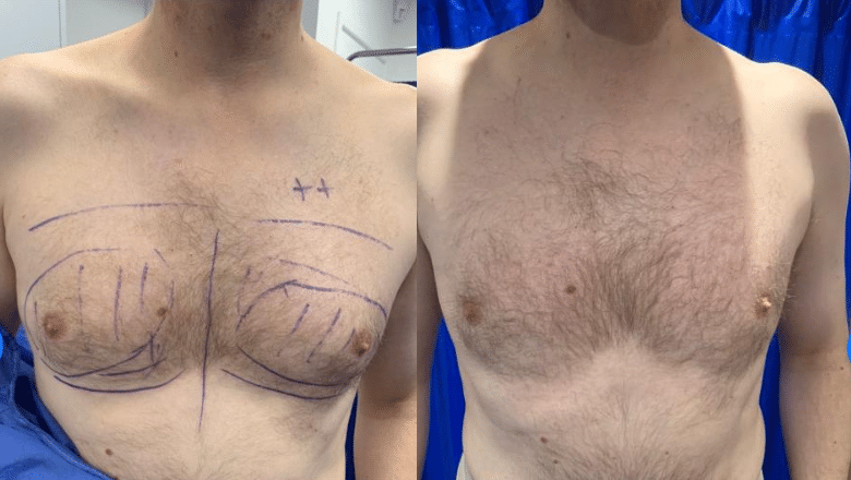 male gyno surgery before and after case 14