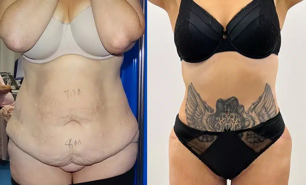 tummy-tuck-6