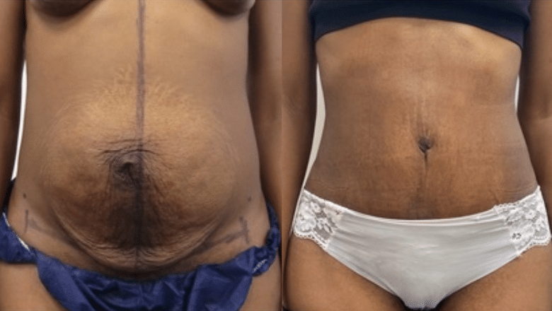 tummy tuck before and after case 18