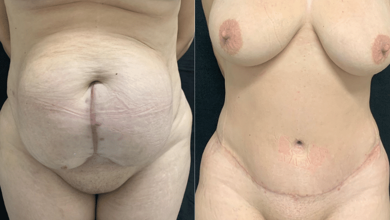tummy tuck before and after case 1 front view