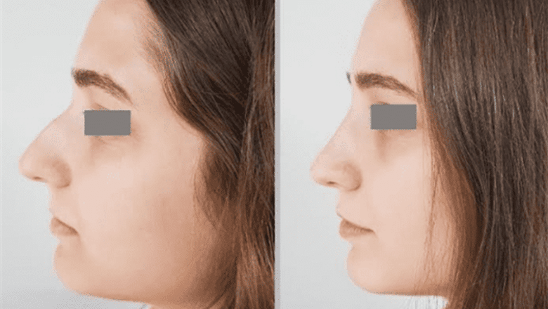 nose bridge rhinoplasty before and after case 4