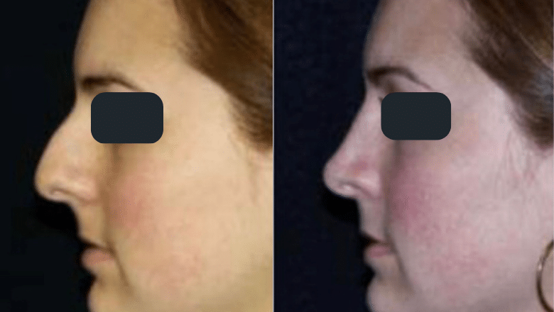 rhinoplasty before and after case 6 front view