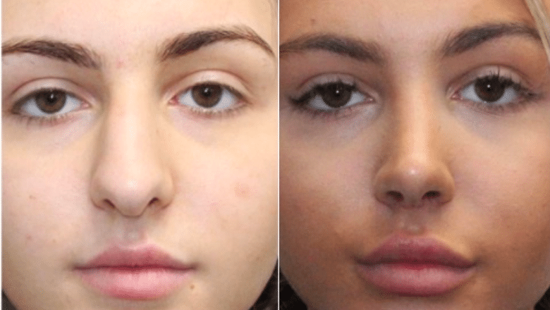revision rhinoplasty before and after case 2 front view