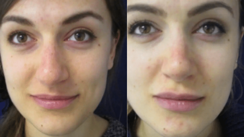 rhinoplasty before and after case 12 front view