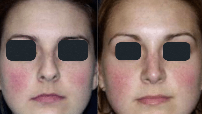 rhinoplasty before and after case 6 side view