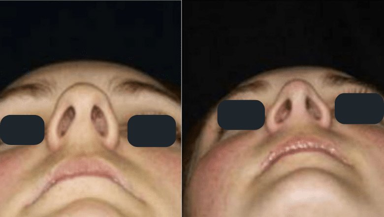 rhinoplasty before and after case 6 oblique view