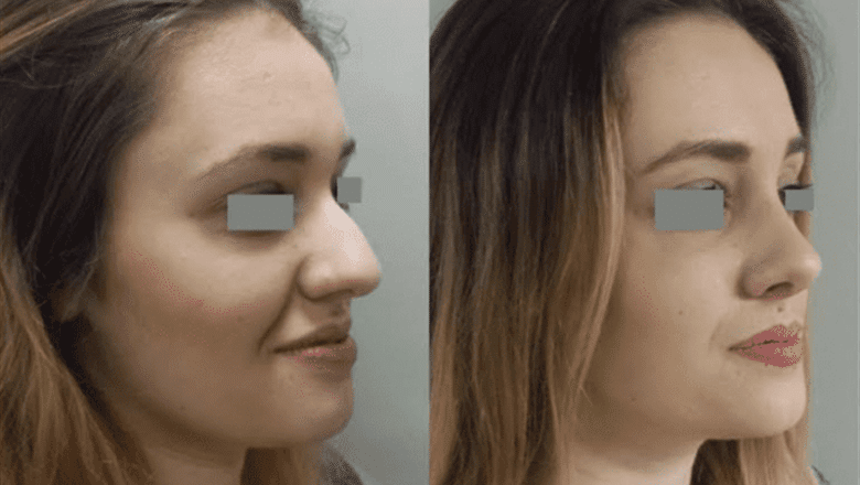 rhinoplasty before and after case 20