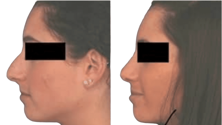 rhinoplasty before and after case 8